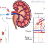 Congenital Nephrotic Syndrome2