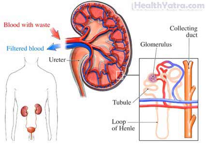 Congenital Nephrotic Syndrome2