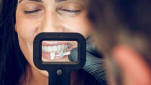 Composite Veneers in Dubai: Affordable Smile Transformation