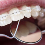 Dental Braces in Dubai 9