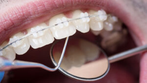 Metal Braces in Dubai: Durable and Effective Orthodontic Care