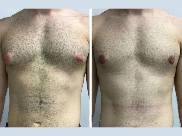 H7 Gynecomastia