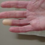 Vibration White Finger