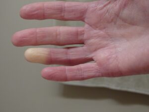How to File a Vibration White Finger Claim in the UK?