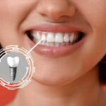 Can Full Mouth Dental Implants Cost Restore Teeth Function and Appearance 3 Can Full Mouth Dental Implants Cost Restore Teeth Function and Appearance