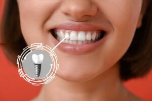 Can Full Mouth Dental Implants Cost Restore Teeth Function and Appearance