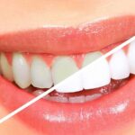 Teeth Whitening Cost in Dubai: Affordable Clinics Guide