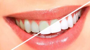 Teeth Whitening Cost in Dubai: Affordable Clinics Guide