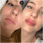 Why Celebrities Prefer Juvederm at the Best Aesthetic Clinics in Dubai
