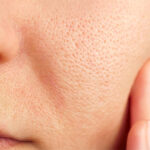 Large Pores Treatment Cost Average Prices and What Affects Them