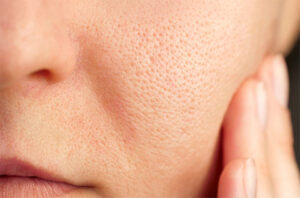 Large Pores Treatment Cost: Price Range for Different Procedures