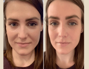 PRP Treatment in Dubai Enhancing Cellular Hair Performance