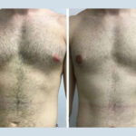 H7 Gynecomastia