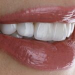VVeneers in dubai 3