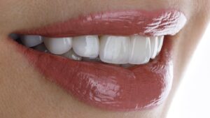 Braces for Overbite Correction in Dubai 1 Braces for Overbite Correction in Dubai