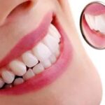 Scaling and Polishing in Dubai 15