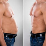 Six Pack Liposuction vs Gym: What Works Better in Dubai? 3 Six Pack Liposuction vs Gym: What Works Better in Dubai?