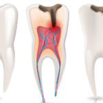 Safe and Effective Root Canal Treatment in Dubai