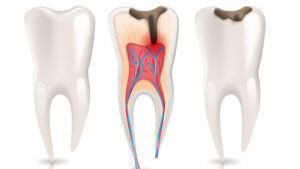 Safe and Effective Root Canal Treatment in Dubai