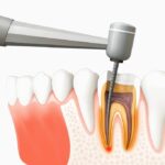 Say Goodbye to Tooth Pain with Root Canal Treatment in Gota Ahmedabad