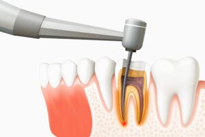 Say Goodbye to Tooth Pain with Root Canal Treatment in Gota Ahmedabad