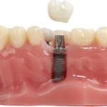 Save Money on Dental Implant Cost In Dubai Safely