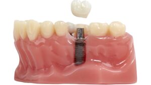 Save Money on Dental Implant Cost In Dubai Safely