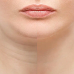 Double Chin Liposuction and Skin Elasticity