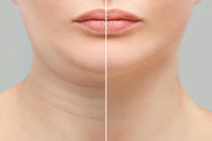 Double Chin Liposuction and Skin Elasticity