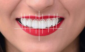 Digital Smile Design in Ghatkopar: Transform Your Smile at OM Datta Dental Clinic 1 Digital Smile Design in Ghatkopar: Transform Your Smile at OM Datta Dental Clinic