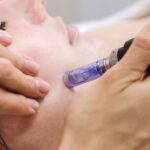 Microneedling In Manchester – Boost Collagen for Healthier, Firmer Skin