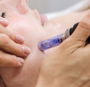 Microneedling In Manchester – Boost Collagen for Healthier, Firmer Skin