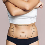 Top Benefits of Liposuction in Dubai for Body Sculpting Goals