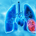 Cardiovascular and Thoracic Surgery in Navi Mumbai at Terna Hospital