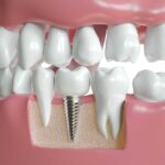 Could Full Mouth Dental Implants Cost Create Teeth That Look Stunning Daily