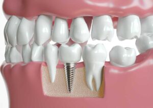Could Full Mouth Dental Implants Cost Create Teeth That Look Stunning Daily 1 Could Full Mouth Dental Implants Cost Create Teeth That Look Stunning Daily