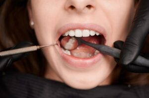 Why Most People Delay a Root Canal-and What It Ends Up Costing Them