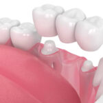 Tooth Crown Dubai: Everything You Need to Know