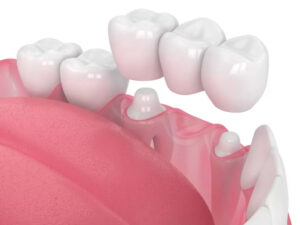 Tooth Crown Dubai: Everything You Need to Know