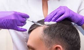 How Successful Are Modern Hair Transplant Procedures?