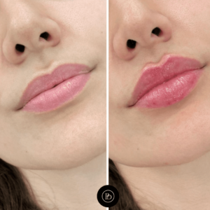 Expert Advice Before Booking Juvederm in Dubai