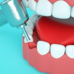 Dental tooth filling 8