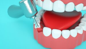 Dental Tooth Filling for Sensitive Teeth Relief