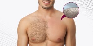 Can Body Hair Be Used for a Successful Hair Transplant?