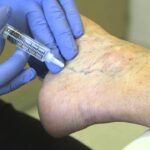 What Causes Spider Veins and How Treatment Helps