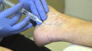 What Causes Spider Veins and How Treatment Helps