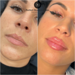 Juvederm Safety Standards Followed by the Best Plastic Surgeon in Dubai