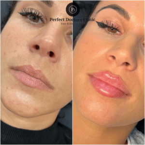 Juvederm Safety Standards Followed by the Best Plastic Surgeon in Dubai