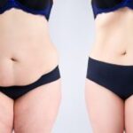 Abdominoplasty Dubai: Recovery Timelines Explained 3 Abdominoplasty Dubai: Recovery Timelines Explained