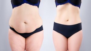 Abdominoplasty Dubai: Recovery Timelines Explained 1 Abdominoplasty Dubai: Recovery Timelines Explained